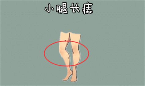 左小腿有痣女|超全！身体30种痣相全解(图)